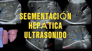 Segmentación Hepática de Couinaud por Ultrasonido La Guía Esencial para Radiología [upl. by Milah411]