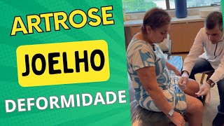 DEFORMIDADE NO JOELHO  ARTROSE HÁ MAIS DE 26 ANOS  artrose joelho fisioterapia acupuntura [upl. by Eelyak]