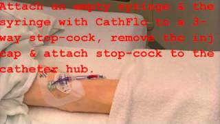 Declotting with CathFlo [upl. by Ellesij]