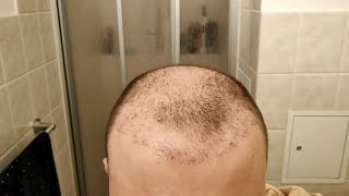 I Stopped Taking Finasteride after Hair Transplant  1 Year Hair Loss Experiment [upl. by Acirne176]