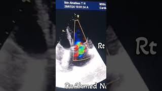 VSD Patch leaks SP TOF repair 😱🙄echocardiogram cardi [upl. by Sldney]