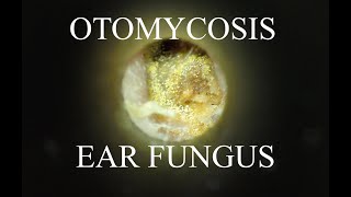 EAR FUNGUS  OTOMYCOSIS  4KHD [upl. by Hettie]