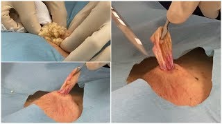 粉瘤epidermoid cyst ブログでも詳しく解説してます。くりぬき法 心斎橋 神戸三宮 ふるばやし形成外科粉瘤クリニック東京新宿院 大阪梅田形成外科クリニック [upl. by Robison]