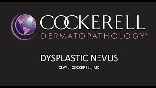 Dysplastic Nevus  Cockerell Dermatopathologys Beliefs [upl. by Letnwahs]