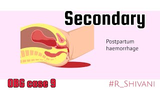 Secondary postpartum haemorrhage  OBG case study 9  RShivani PharmD PPH [upl. by Nadia]