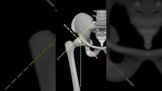 Lower Limb Axis amp Weight Alignment for AboveKnee Prosthesis  anatomy artificiallimb [upl. by Audra]