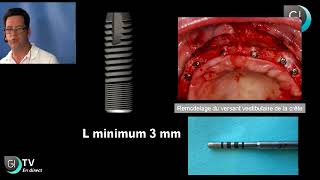 Implants Dentaires  Lexpansion osseuse [upl. by Mcmath]