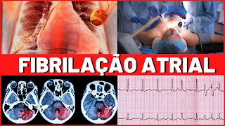 FIBRILAÇÃO ATRIAL  O QUE É  CAUSAS  TRATAMENTO  É GRAVE  TUDO QUE VOCÊ PRECISA SABER [upl. by Junius]