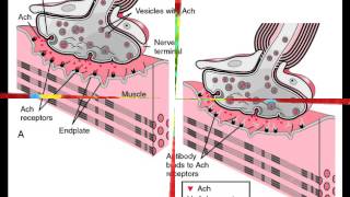 Myasthenia Gravis [upl. by Eremihc]