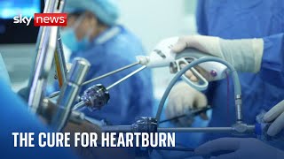 Heartburn Revolutionary surgical procedure cures condition with a device [upl. by Zzahc]