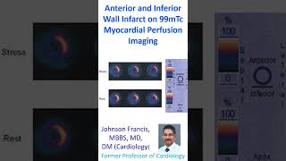 Anterior and inferior wall infarct on 99mTc myocardial perfusion imaging [upl. by Derfla]