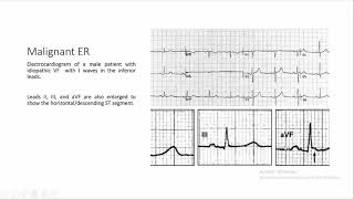 early repolarization [upl. by Niad]