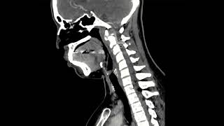 Calcifications of the longus colli [upl. by Pate]