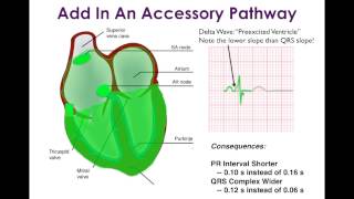 WolffParkinsonWhite WPW and Associated Arrhythmias [upl. by Analed]