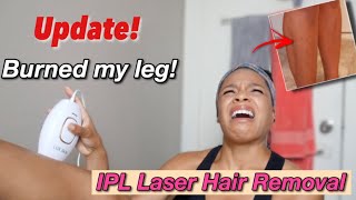 Burned My Leg with IPL Laser Hair Removal 2 MONTH UPDATE  Lux Skin [upl. by Asilaj96]