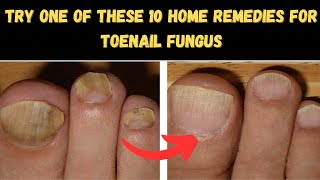 10 Home Remedies for Toenail Fungus [upl. by Gadmon]