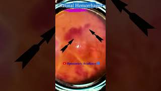 Retinal Hemorrhages  Eales disease  Fundus Photography  Short Video 93 science [upl. by Flavian]