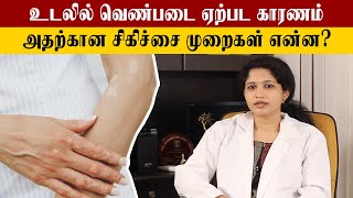 How to Cure Vitiligo  வெண்படை போக்குவது எப்படி  Samayam Tamil [upl. by Abdulla550]