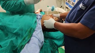 Extubation after surgery [upl. by Shere]