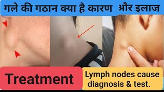 गले की गांठ क्या है कारणजांचइलाजlymph nodesneck nodes treatment cause diagnosistest [upl. by Horan]