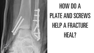 How does a plate and screws help a broken bone heal [upl. by Ahsaenat254]