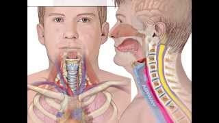 Complications of ACDF  Hematoma Formation  Airway Obstruction  Colorado Spine Surgeon [upl. by Light]