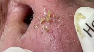 Nose Blackheads Removal with Haris Beauty  2022 [upl. by Greenebaum554]