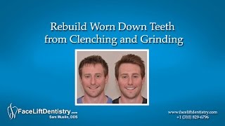 Rebuild Worn Down Teeth from Clenching and Grinding [upl. by Analah]