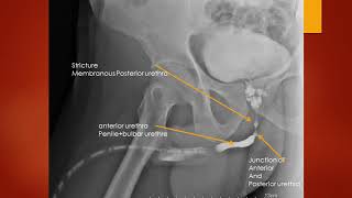 CASE 505 ascending retrograge urethrography stricture posterior memberanous posterior urethra [upl. by Anoniw]