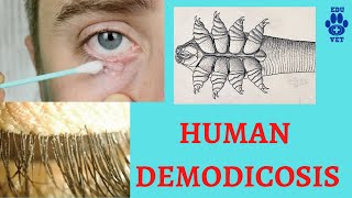 Human Demodicosis [upl. by Dianne]