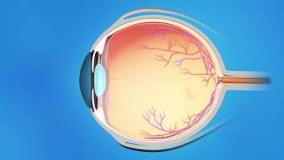 Understanding Glaucoma [upl. by Sezen]