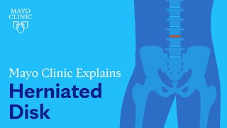 Mayo Clinic Explains Herniated Disk [upl. by Rasec]