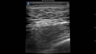 Locating the thoracodorsal artery [upl. by Rorke]