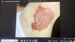 Psoriasis Full Hindi  Psoriasis  Skin Disease  Skin psoriasis psoriasiscure psoriasissolution [upl. by Valina533]