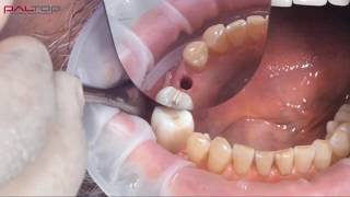 PALTOP Flapless Guided Implant Surgery using PAI  Dr Michael Klein [upl. by Retswerb]