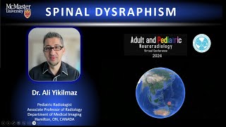 Spinal Dysraphism  brief [upl. by Assilana]