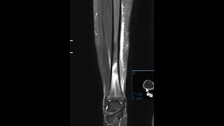 Osteomyelitis of tibia with follow up [upl. by Pandich]