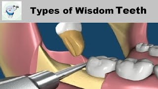 Types of Wisdom Teeth Removal [upl. by Ketty]