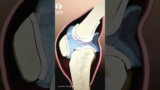 Arthrite du genou expliquée  Les bases à connaître pour prendre le contrôle [upl. by Nnylatsirk]