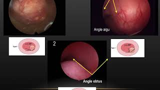 Pathologie Utérine Polype Fibrome Adenomyose CloisonCorrélation Echographie Hysteroscopie [upl. by Suryc]