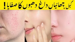 Acne amp Freckle Treatment Cream  Best Treatment for acne and oiliness blackheads and enlarged pores [upl. by Eltsryk696]