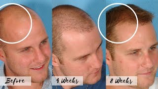 CURE FOR BALDNESS  Stop the Receding Hairline  Natural Hair Regrow Treatment [upl. by Trudey218]