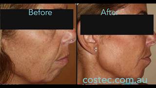 HIFU™ treatment  Before amp After pictures for Face Lift and Skin Tightening [upl. by Tnomad]