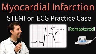 Myocardial Infarction  STEMI on ECG  Practice EKG [upl. by Cassidy]