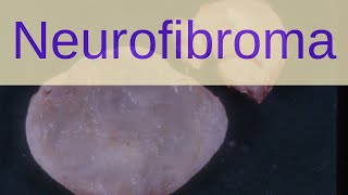 What is a Neurofibroma  Pathology mini tutorials [upl. by Eidualc394]