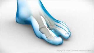 Bunion Surgery [upl. by Sandeep486]