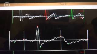 Electrocardiogram using Arduino and ECGEKG shield [upl. by Alolomo]