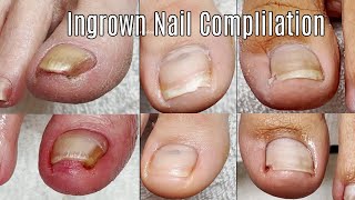 Ingrown Toenail Cleaning Compilation [upl. by Alistair]