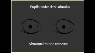 Paradoxical Pupillary Response [upl. by Tarsuss418]