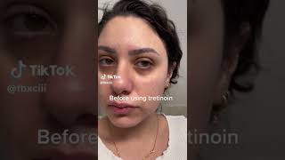 Tretinoin Results After One Month retinol retina [upl. by Atinal]